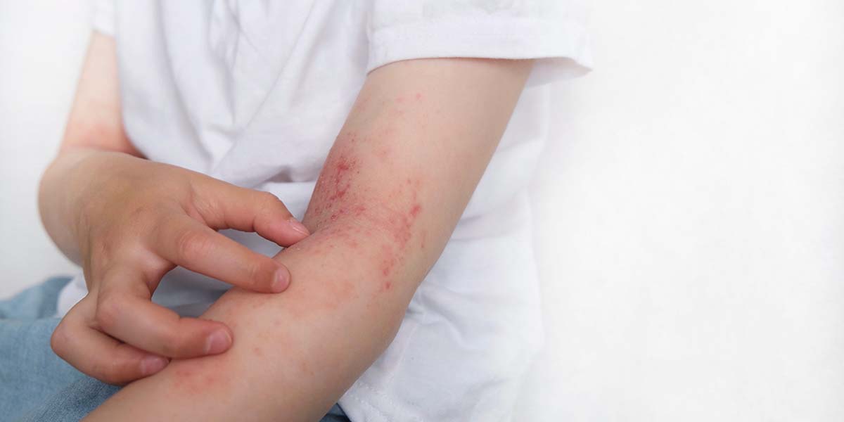 Child with eczema