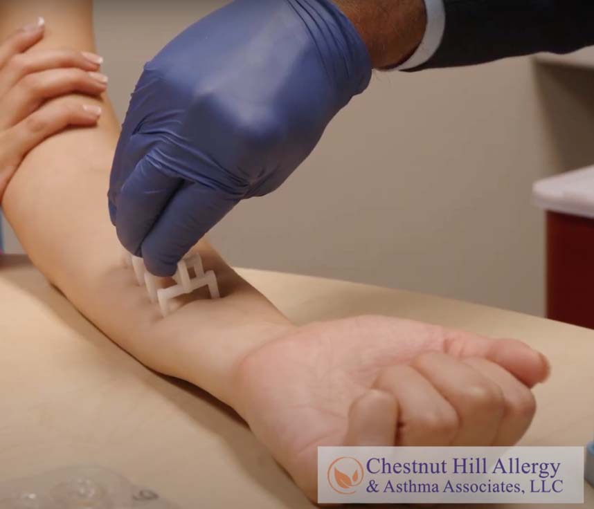 Eczema testing done at Chestnut Hill Allergy in Philadelphia